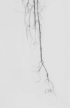 Femoral artery angiogram or angiography  at lower extremity area.