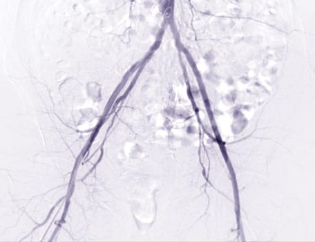 Femoral artery angiogram or angiography 