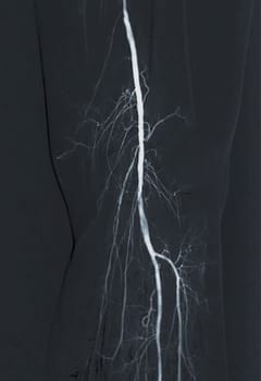 Femoral artery angiogram or angiography 