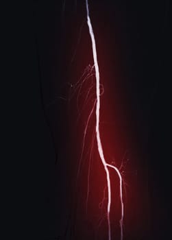 Femoral artery angiogram or angiography 