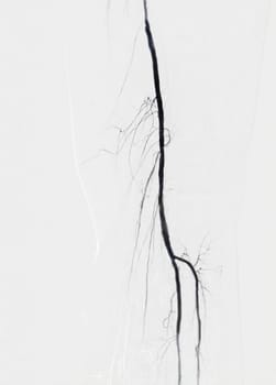 Femoral artery angiogram or angiography 