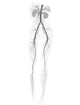 CTA femoral artery run off showing  femoral artery for diagnostic  Acute or Chronic Peripheral Arterial Disease.