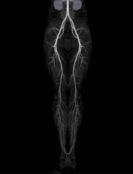 CTA femoral artery run off showing  femoral artery for diagnostic  Acute or Chronic Peripheral Arterial Disease.