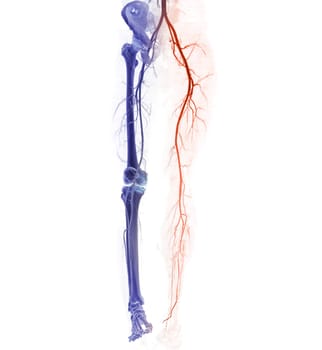 CTA femoral artery run off showing  femoral artery for diagnostic  Acute or Chronic Peripheral Arterial Disease.