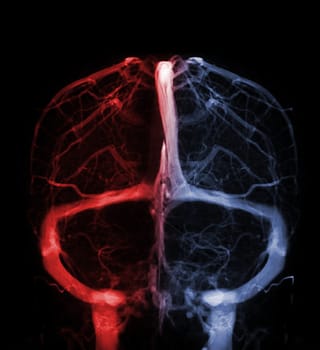 Cerebral  Venograpgy for diagnosisi Cerebral Venous Thrombosis