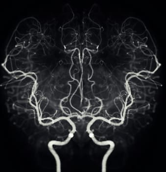 Cerebral angiography  image from Fluoroscopy in intervention radiology  showing cerebral artery.