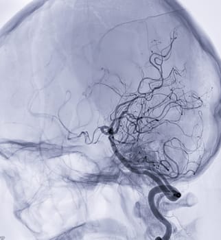 Cerebral angiography  imageor potesterior cerebral artery from Fluoroscopy in intervention radiology  showing cerebral artery.