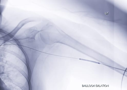 Angioplasty, balloon angioplasty and percutaneous transluminal angioplasty (PTA) on Left arm.