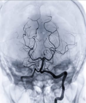 Cerebral angiography  imageor potesterior cerebral artery from Fluoroscopy in intervention radiology  showing Basilar artery.