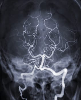 Cerebral angiography  imageor potesterior cerebral artery from Fluoroscopy in intervention radiology  showing Basilar artery.