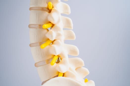 Lumbar spine displaced herniated disc fragment, spinal nerve and bone. Model for treatment medical in the orthopedic department.