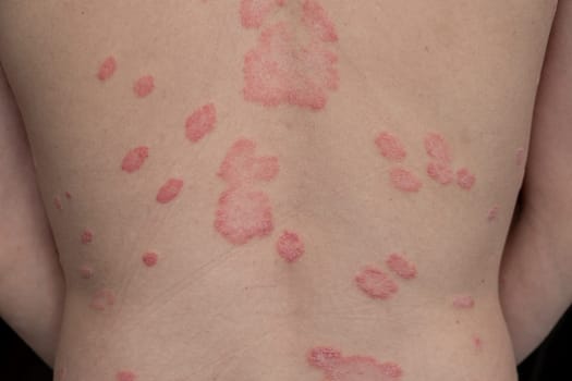 Psoriasis Vulgaris, skin patches are typically red, itchy, and scaly. Papules of chronic psoriasis vulgaris on male hand, back and body. Genetic immune disease. Detail of psoriatic skin disease