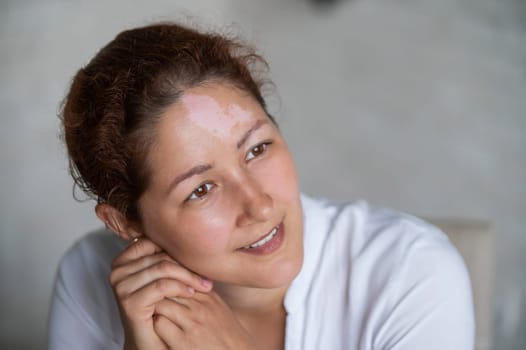 Portrait of a smiling woman with Vitiligo Disease