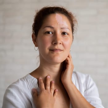 Vitiligo. Portrait of a beautiful smiling woman with lack of skin pigmentation on her forehead. A girl with a white spot on her face. Autoimmune disease