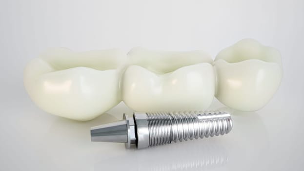 Dental implant: a blend of modern dentistry and precision. A durable solution for missing teeth, merging seamlessly with the jaw for function and appeal.