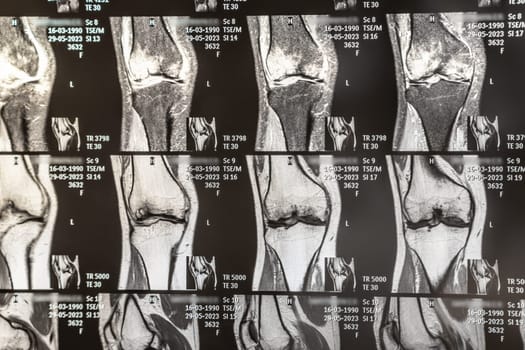 Knee joint x-ray or MRI. Doctor pointed on area of knee joint, where pathology or problem is detected, such fracture, destruction of joint, osteoarthritis.