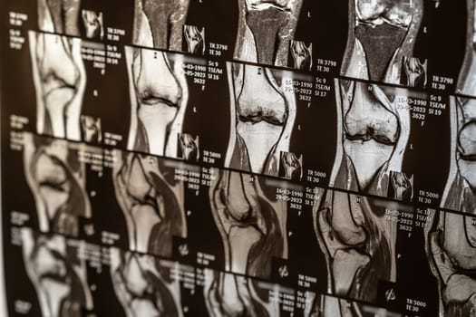 Knee joint x-ray or MRI. Doctor pointed on area of knee joint, where pathology or problem is detected, such fracture, destruction of joint, osteoarthritis, magnetic resonance enterography.