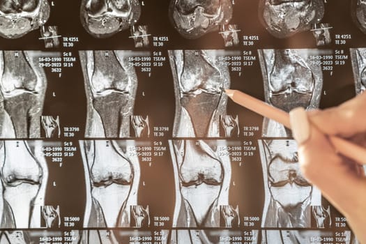 Knee joint x-ray or MRI. Doctor pointed on area of knee joint, where pathology or problem is detected, such fracture, destruction of joint, osteoarthritis, magnetic resonance enterography.