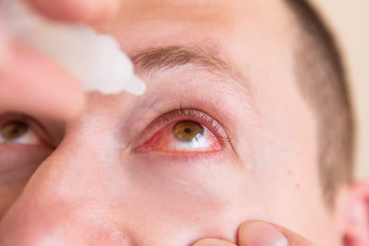 Take care of his eyes. Portrait of a young man with a very red eye dripping drops into his eyes. Close-up