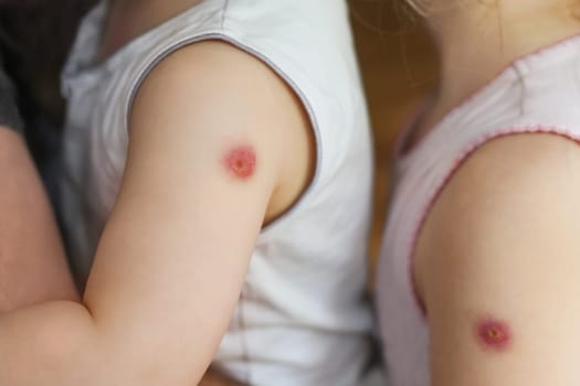 Hands of a children with a reaction to the BCG vaccine