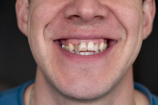 A man's crooked teeth. Young man showing crooked growing teeth. The man needs to go to the dentist to install braces.
