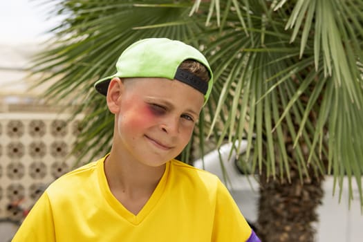 a boy with a black eye sits in the park, portrait of a boy in a cap with a black eye. High quality photo