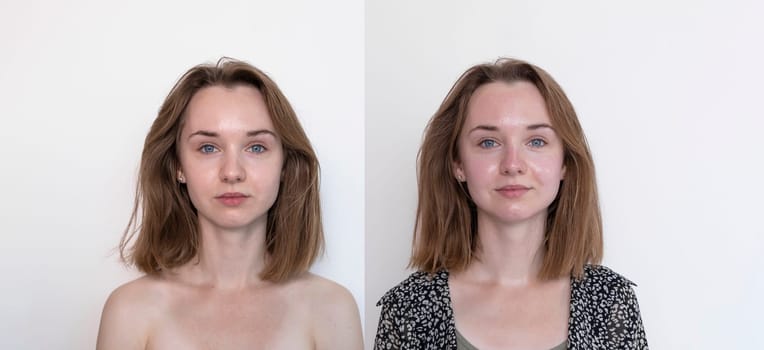 Before and After Mesotherapy And Microneedling Treatment. Portrait Of Real Female Patient After Beauty Invasive Cosmetic Procedure Using Thin Needles. Microdermabrasion, Horizontal Plane.