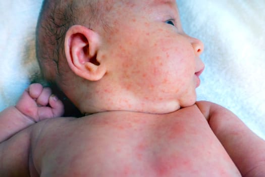 baby allergy skin. child dermatitis symptom problem rash. suffering atopic symptom on skin cheeks. concept child health. allergic reaction miliaria, prickly heat on baby's back.