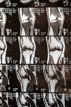 Knee joint x-ray or MRI. Doctor pointed on area of knee joint, where pathology or problem is detected, such fracture, destruction of joint, osteoarthritis.