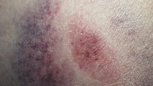 Big bruise hematoma after hit on human body skin. Congestion, macro. Health injury, pain, trauma concept. Domestic violence, home abuse. High quality photo