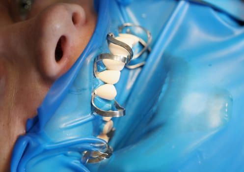 Patient at dentist office to install dentures or veneers closeup. Dental prosthetics concept