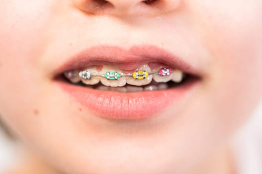 Close-up of the mouth of a girl with rainbow braces.
