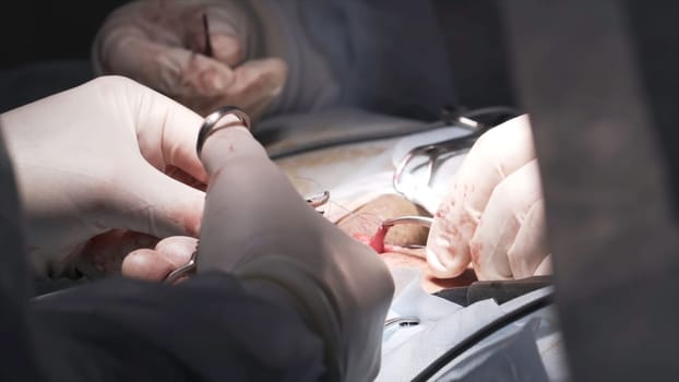 Close up details of a surgery process in a sterile room. Doctors wearing safety gloves performing operation with surgery tools and saving life of a patient, medicine concept.