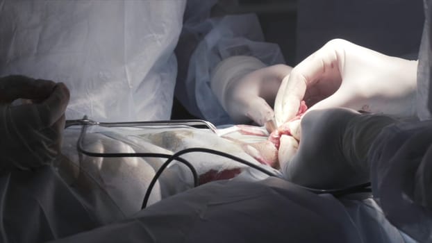 Close up detail of a surgery on male genitals with the professional equipment. Surgeons in sterile suits performing medical procedure, process of prostatectomy.