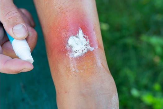 This is a photograph of a man applying antiseptic ointment to a red rash on his arm