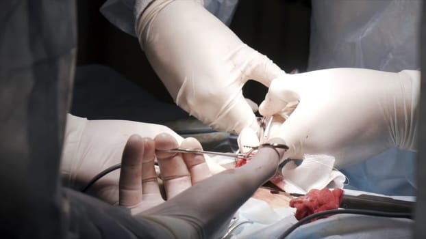 Surgical team operating male genitals in an operation theater. Close up of surgeons removing the tumor from the testicle of a man patient, cancer and medicine concept.