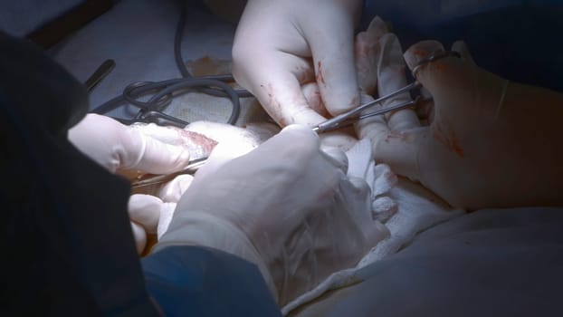 Close-up of surgeon performing operation. Action. Focused and serious surgery by surgeon. Professional surgeon at work on operation with anesthesia.
