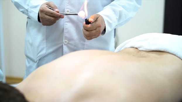 Acupuncture therapist placing a cup on the back of a male patient, ancient Chinese alternative medicine. Close up for a doctor giving cupping treatment on young man back