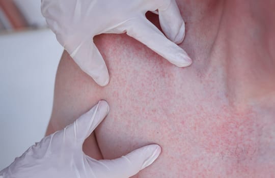 Doctor hands in gloves examining red rash on patient skin closeup. Diagnosis and treatment of allergic urticaria concept