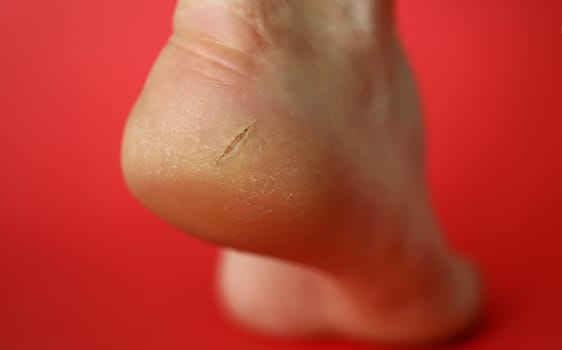 Close-up of female gam exposed to camera on lower view angle. Heel of dry leg covered with cracks. Moisturizing cream advertisement concept. Isolated on red background