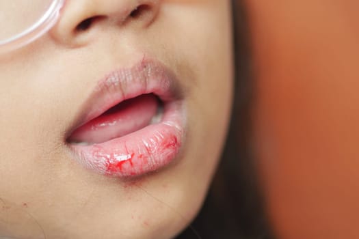 close up of dry lip of a child ,