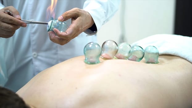 Acupuncture therapist placing a cup on the back of a male patient, ancient Chinese alternative medicine. Close up for a doctor giving cupping treatment on young man back