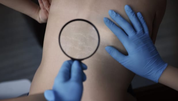 Doctor examining stretch marks on patients back using magnifying glass closeup. Hormonal disorders concept