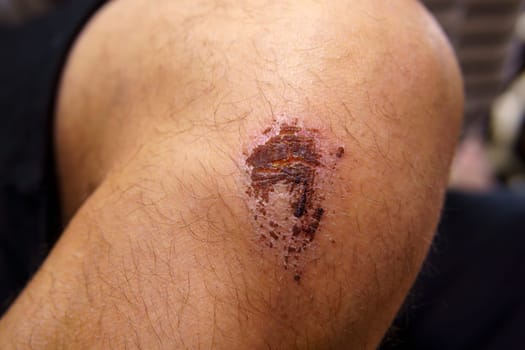Close up of a wound on a person leg, selective focus. A man leg