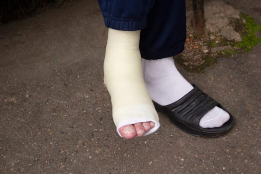 Broken leg in plaster. Damage to limb. Human legs. Plaster on foot. Damage to health.