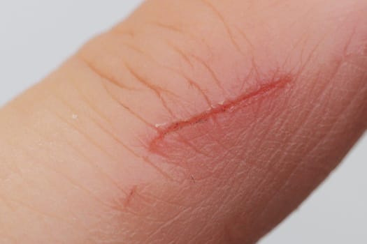 A healing scratch on a man's finger.