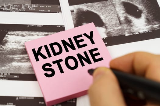 Medical concept. On the ultrasound pictures there are stickers that say - Kidney stone