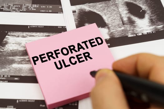 Medical concept. On the ultrasound pictures there are stickers that say - Perforated ulcer