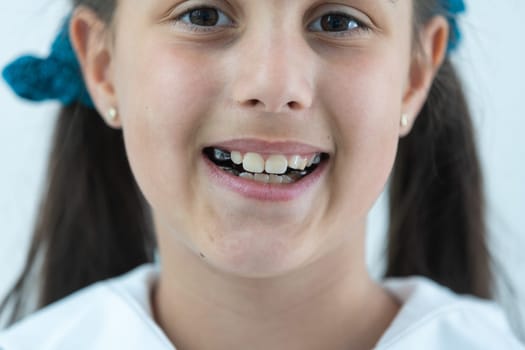 a little girl with a shifted dentition demonstrates her teeth