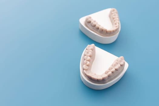 Gypsum Model Plaster For Teeth Molar, Dental Mold In Laboratory On Blue Background. Human Jaw. Tooth Cast For Invisible Braces, Aligner Or Night Guard For Bruxism, Dentures. Copy Space For Text